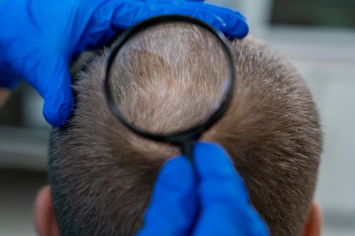 Understanding Hair Loss and Scalp Health